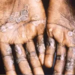 lutte-contre-la-variole-du-singe-le-ministere-des-eaux-et-forets-prend-des-mesures-strictes