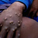 variole-de-singe-l-union-africaine-pourrait-decreter-une-urgence-de-sante-publique