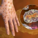 mauritanie-les-autorites-renforcent-leur-engagement-face-a-l-epidemie-de-variole