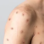 sante-mondiale-cette-nouvelle-souche-de-la-variole-du-singe-qui-inquiete-l-oms-et-l-union-africaine