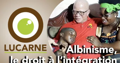 lucarne-albinisme-le-droit-a-l-integration