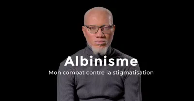 mon-combat-contre-la-stigmatisation-des-albinos