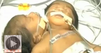 un-bebe-a-deux-tetes-nait-en-inde