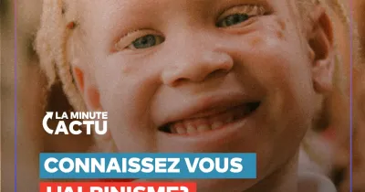 13-juin-journee-internationale-de-sensibilisation-a-l-albinisme
