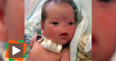 a-17-mois-elle-vit-sans-nez